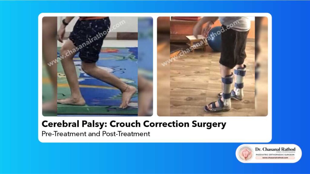 Cerebral Palsy Crouch Correction Surgery Dr. Chasanal Rathod